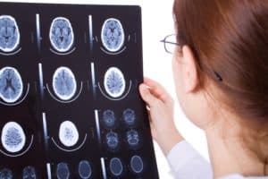 Traumatic Brain Injury Attorney Chicago, IL and Doctor review scans of Brain Injury Patient