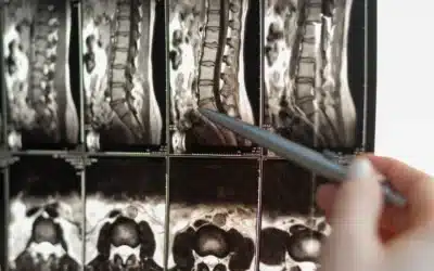 Can You Get Disability for Spinal Stenosis?