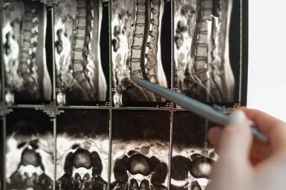 spinal stenosis disability benefits, imaging of spine, Disparti Law Group